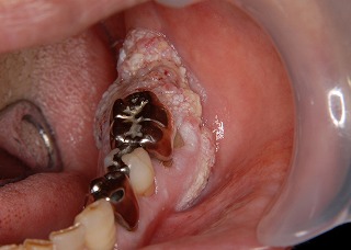 隆起したタイプの歯肉がん。