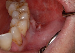 潰瘍タイプの歯肉がん。