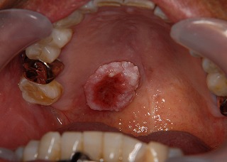 口腔がん がんの標準治療 徳島大学病院 がん診療連携センター