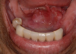 お口の中に湯葉 ゆば のような白い粘膜ができる原因と対策 単身合理主義