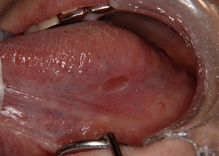 補綴物（入れ歯や歯のかぶせ物）の鋭縁が常に刺激し、舌に潰瘍を形成。