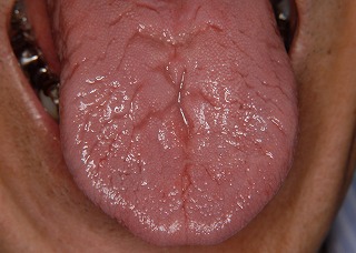 舌背の表面に多数の溝がみられる状態。通常は自覚症状はない。
